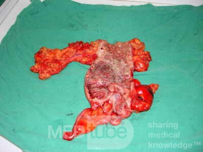 Severe case of Ischemic Colitis (15 of 19)