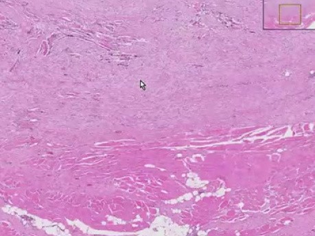 Desmoid tumor - Histopathology - Abdomen