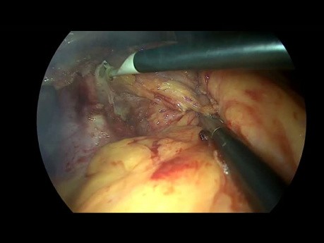 Subtotal Gastrectomy for Large Fundus GIST with Haemostasis Splenectomy