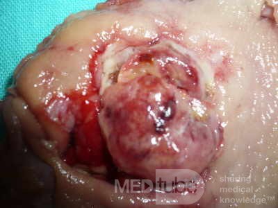 Gastrointestinal Stromal tumor (GIST) (54 of 65)
