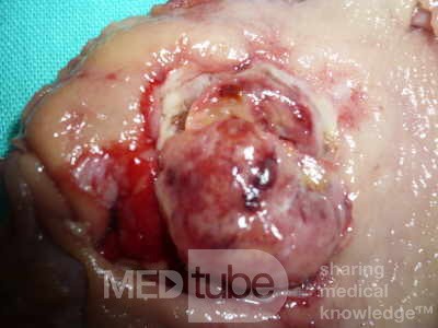 Gastrointestinal Stromal tumor (GIST) (54 of 65)
