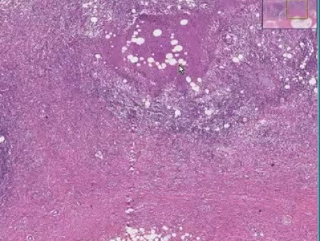 Lymphogranuloma