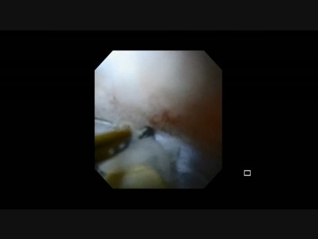 Forniceal Diverticulum Stones