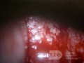 Cervical adenocarcinoma (carcinoma glandulare colli uteri)