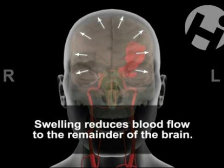 Brain Injury