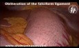 Obliteration of the Falciform Ligament