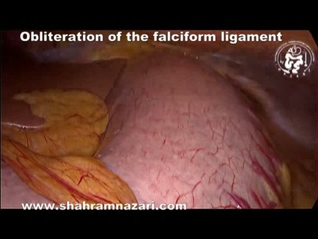 Obliteration of the Falciform Ligament
