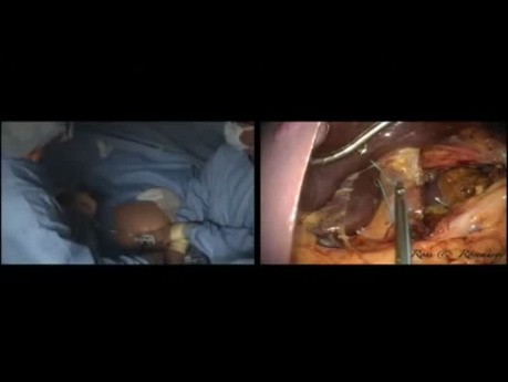 The Standardization of Laparo-Endoscopic Single Site (LESS) Nissen Fundoplication