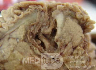 Cholangiocarcinoma that infiltrated a Periampullary Duodenal Diverticula and the head of the pancreas (12 of 20)