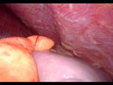 Colonic Perforation With Peritonitis - Laparoscopy (39 of 46)