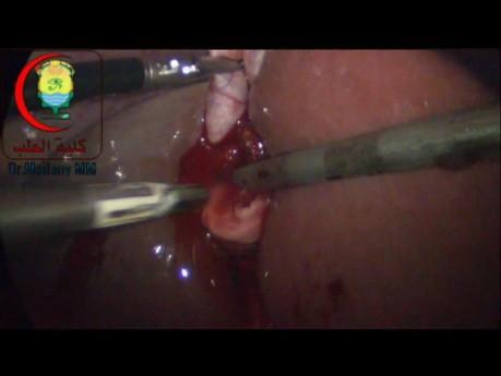 A Piece of Gauze May Be Mandatory to Control Bleeding