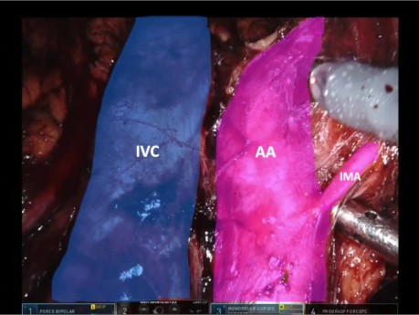 Primary Robot Assisted Retroperitoneal LND in a Patient with Adenocarcinoma of Testis