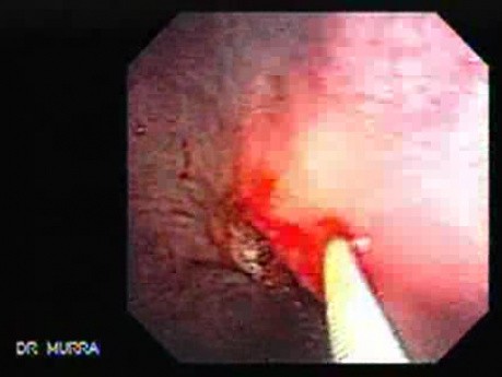Gastric Cicatrization With Pylorus Stenosis (14 of 23)