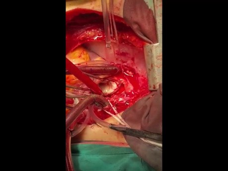 Commando Operation for Patient with Huge LA Tumor Extending from all PV to LA and Mitral Valve 
