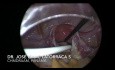 Utility of Laparoscopy in the Placement of a Tenckhoff Type Catheter