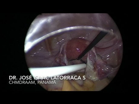 Utility of Laparoscopy in the Placement of a Tenckhoff Type Catheter