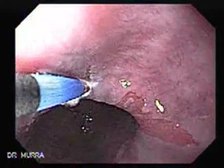 Barrett's Esophagus of long segment (5 of 11)