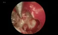 Cholesteatoma Surgery (Endoscopic and Microscopic)