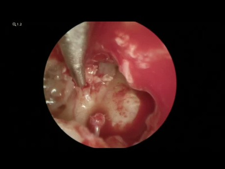 Cholesteatoma Surgery (Endoscopic and Microscopic)