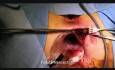 Recurrent Anterior Anal Fistula, LIFT #2