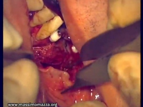 Regeneration Of Multialveolar Process (Right-Side) (2/3)