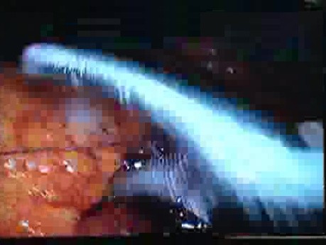 Jejunal Gastrointestinal Stromal tumor (GIST) (62 of 86)