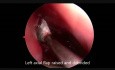 Left Frontal Sinus Tumor Modified Lothrop (Draf III)