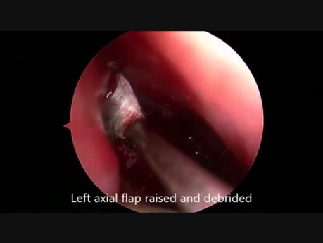 Left Frontal Sinus Tumor Modified Lothrop (Draf III)