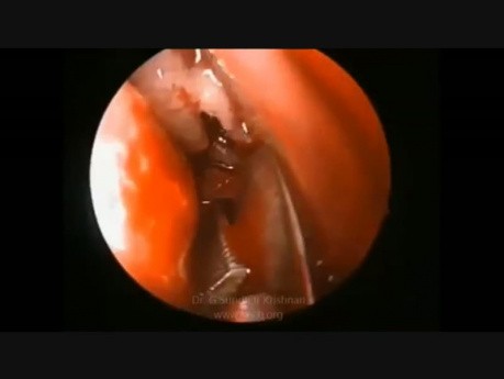 Functional Endoscopic Sinus Surgery (FESS)