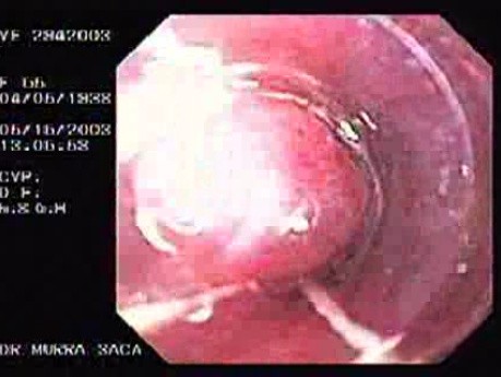 Banding of Esophageal Varices - Suctioning and Banding of the Varix