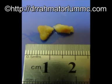 The Tonsillar Cleft - Removal Of Entrapped Cheesy Substance