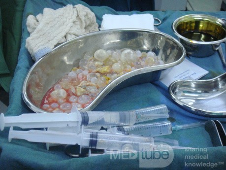 Liver hydatid cyst - daughter cysts