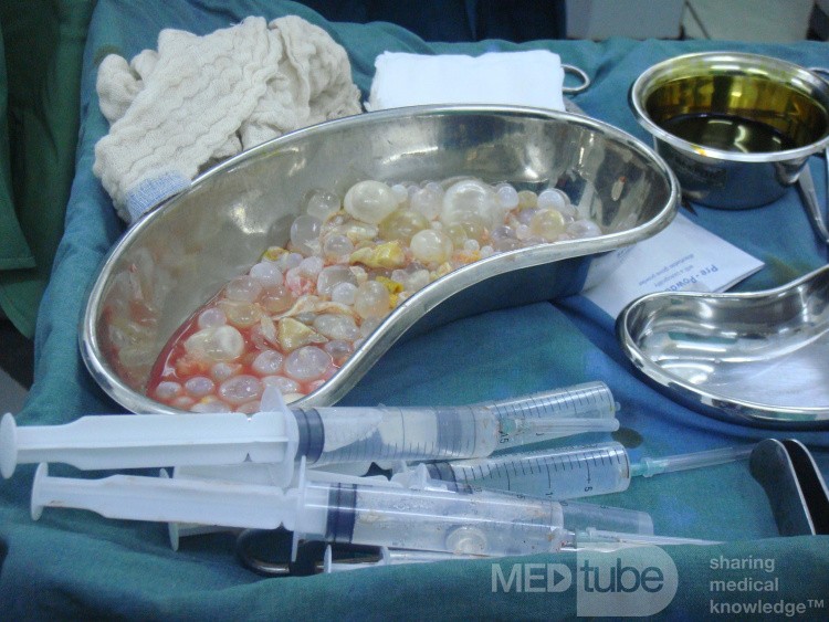 Liver hydatid cyst - daughter cysts
