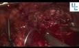 Partial Nephrectomy with Selective Arterial Clamping in a Solitary Kidney