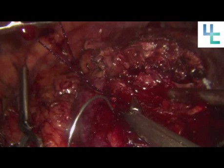 Partial Nephrectomy with Selective Arterial Clamping in a Solitary Kidney