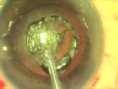 Cataract - New Approach For The Surgery Of Small Eyes