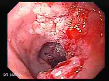 Esophageal Squamous Cell Carcinoma of the the upper third of the Esophagus (2 of 3 )