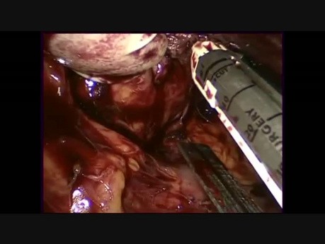 Hand Assisted Laparoscopic Splenectomy: How to Avoid Conversion in a Difficult Case