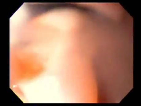 Severe Epistaxis - Case Study  (3 of 8)