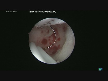 Hysteroscopic Correction of Isthmocele Small Defect