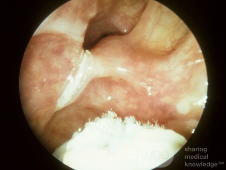 Maxillary Sinus Fungus Ball