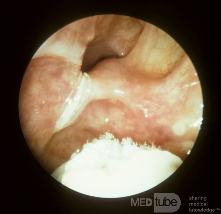 Maxillary Sinus Fungus Ball