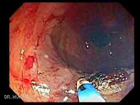 Giant Tubulo - Villous Adenoma (15 of 17)