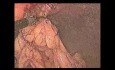 Laparoscopic Repair of Ventral Hernia