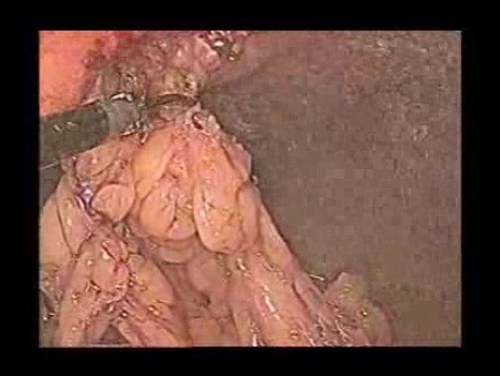 Laparoscopic Repair of Ventral Hernia