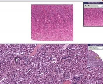 Kidney - Nephrocalcinosis