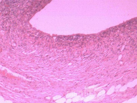 Multiple Rectal Ulcers (102 of 110)