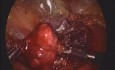 Solitary Renal Cell Carcinoma Metastasis - 2.5 yrs After Right Nephrectomy