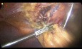 Previous Upper Abdominal Surgery During Lap Chole