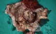 Mixed Mullerian Tumour Of The Uterus